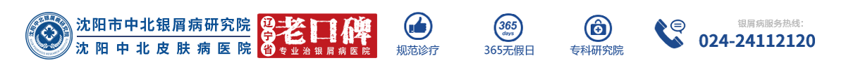 「沈陽中北牛皮癬醫院」-沈陽牛皮癬?？漆t院-沈陽銀屑病醫院哪個正規-沈陽看效果好的銀屑病